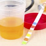 Proteinuria alta