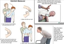 Manovra Heimlich