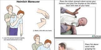 Manovra Heimlich