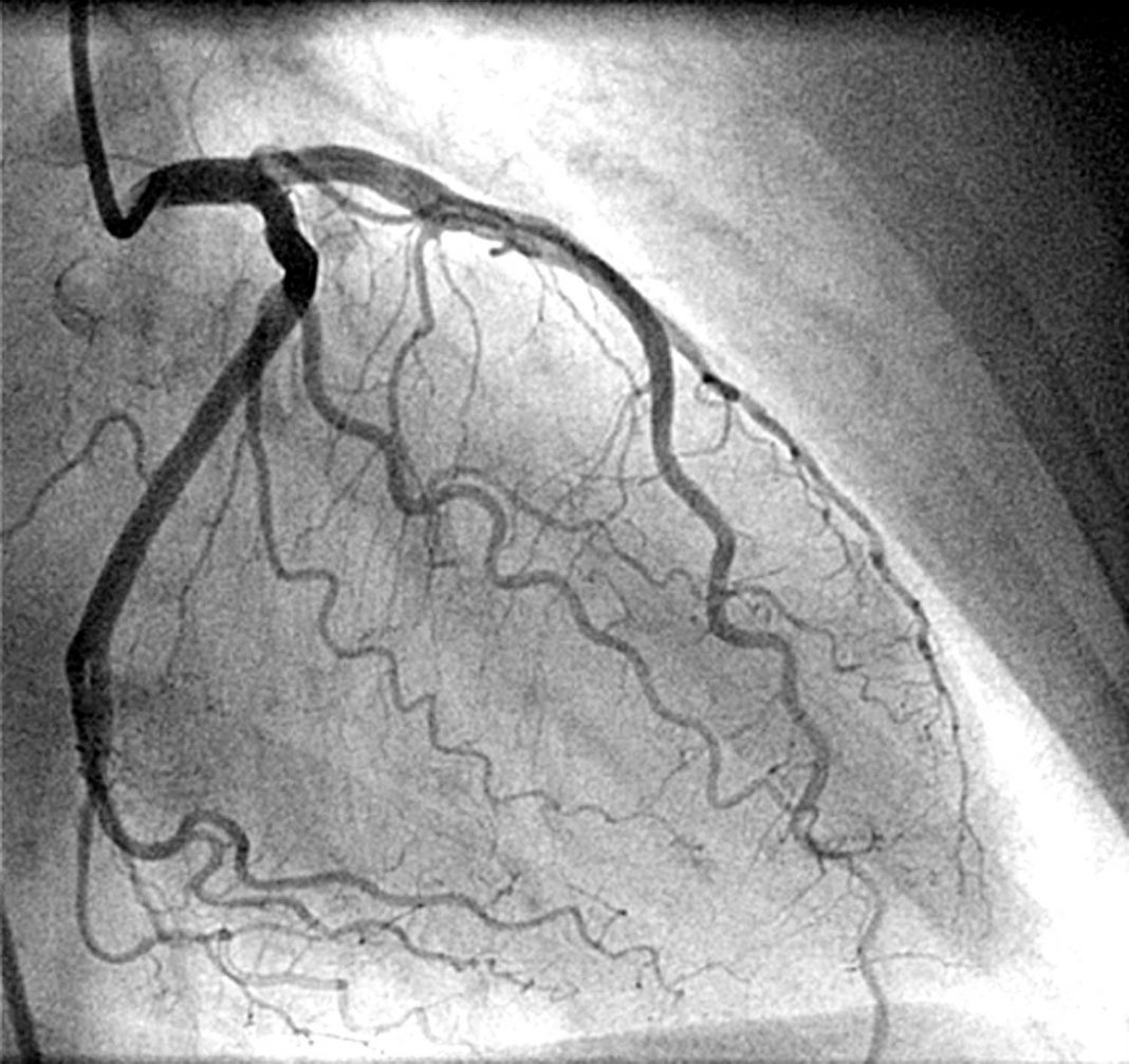 Angiografia Cerebrale, Coronarica E Oculare: Guida Completa All'Esame!