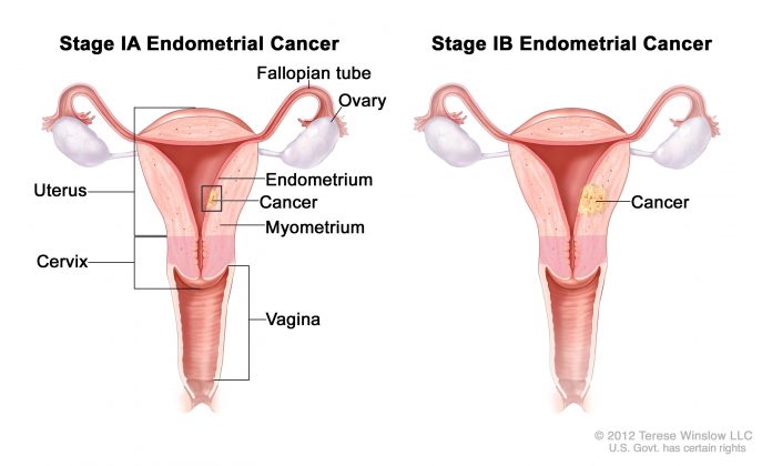 biopsia-endometrio-scopri-la-procedura-ed-i-risultati-dell-esame