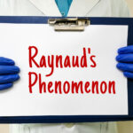 fenomeno o sindrome di raynaud